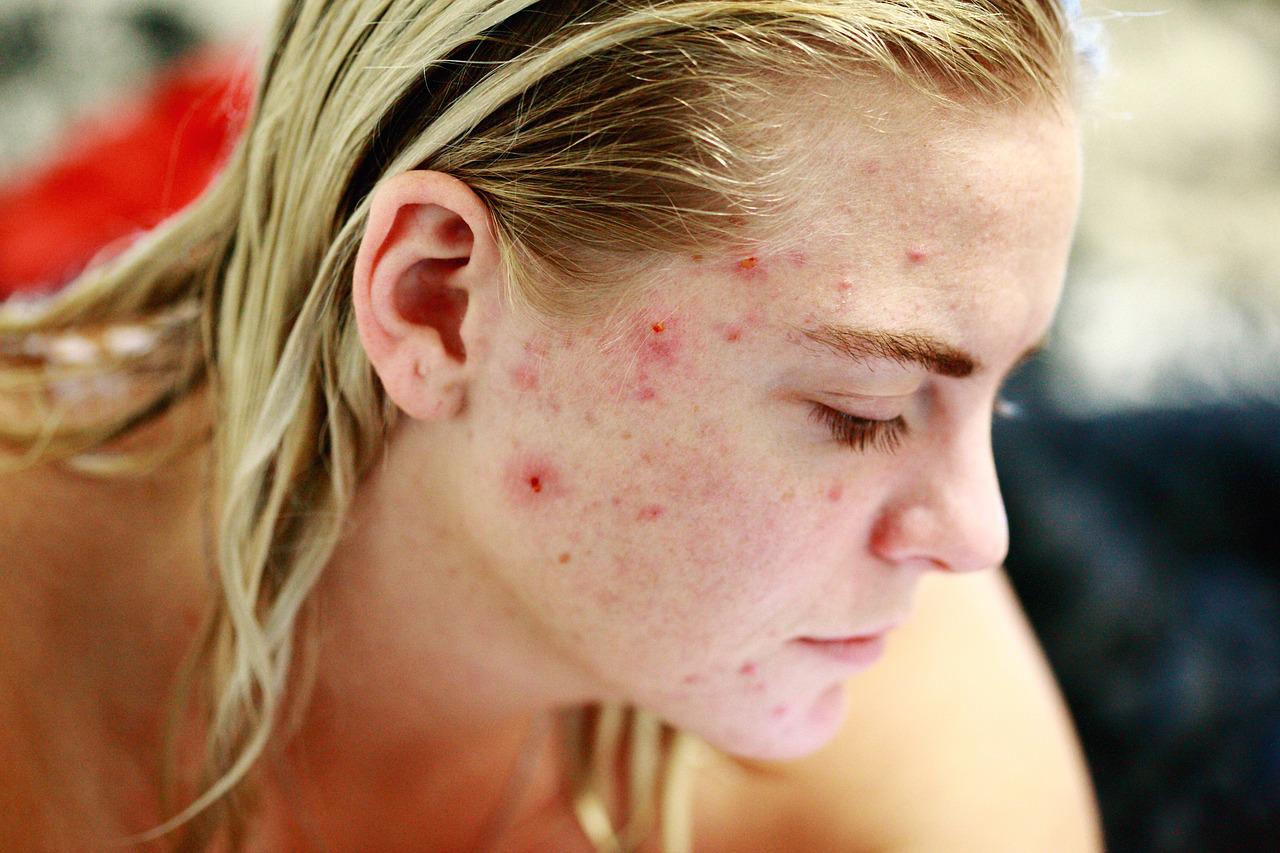 How Do I Contact Curology Customer Service? 1 acne
