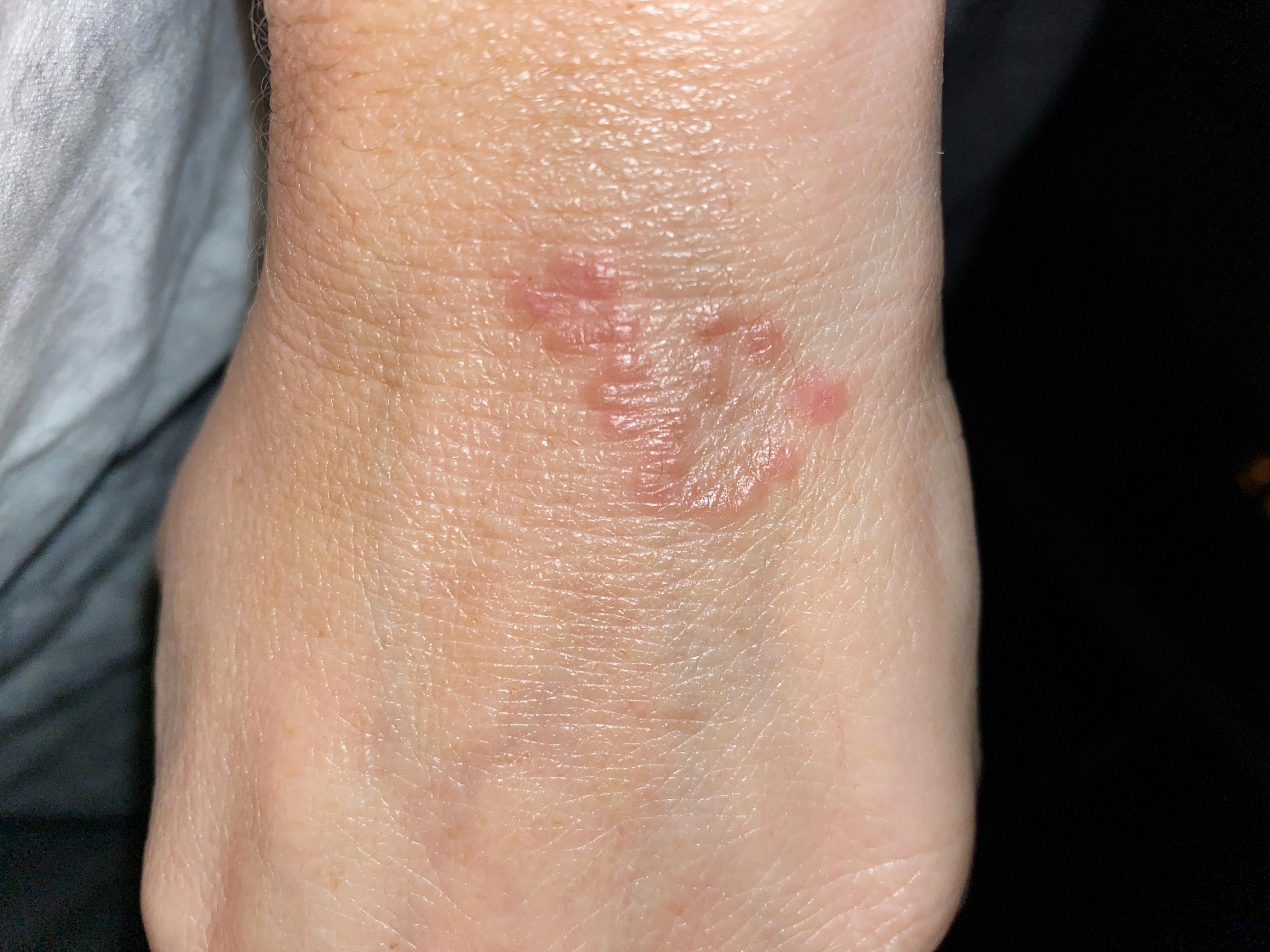 apple watch rash apple watch rash