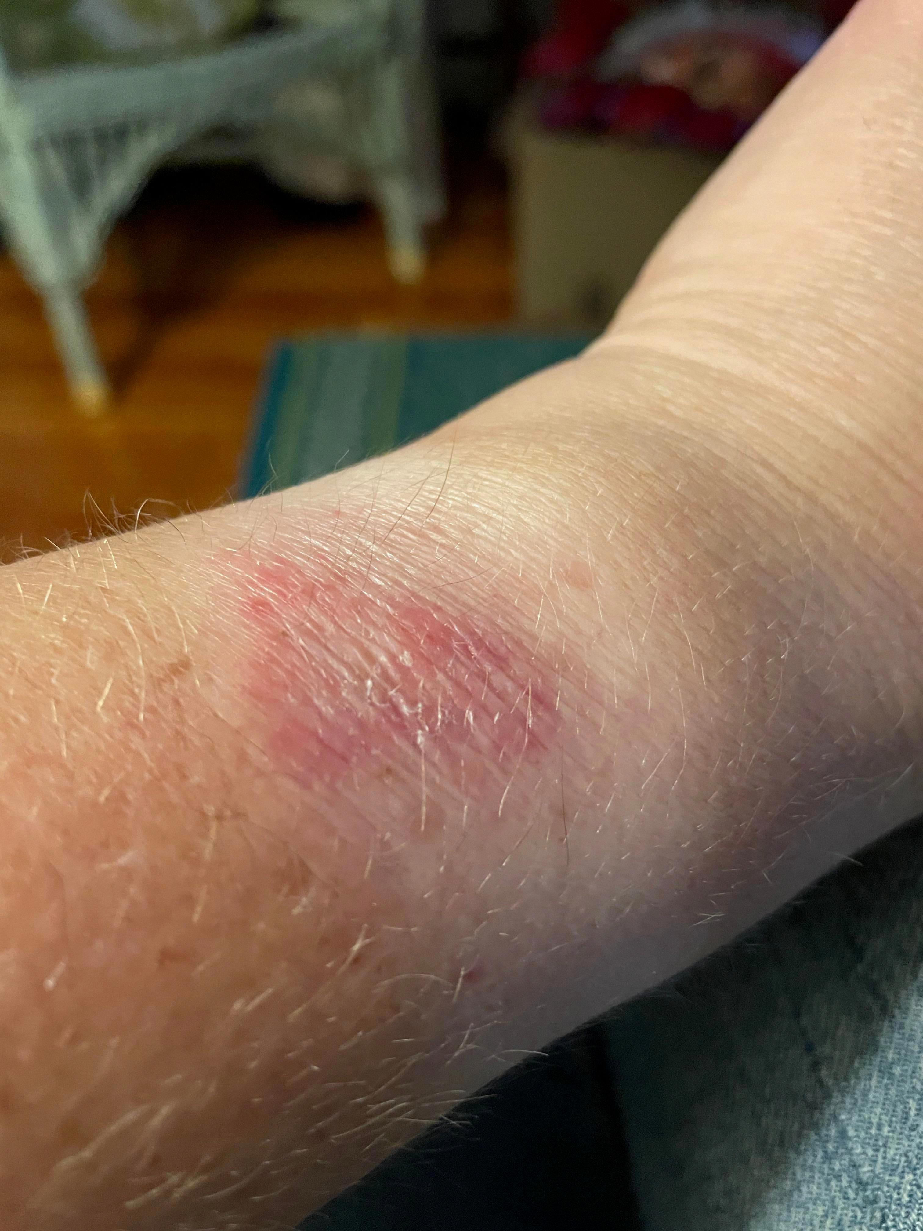 apple watch rash apple watch rash