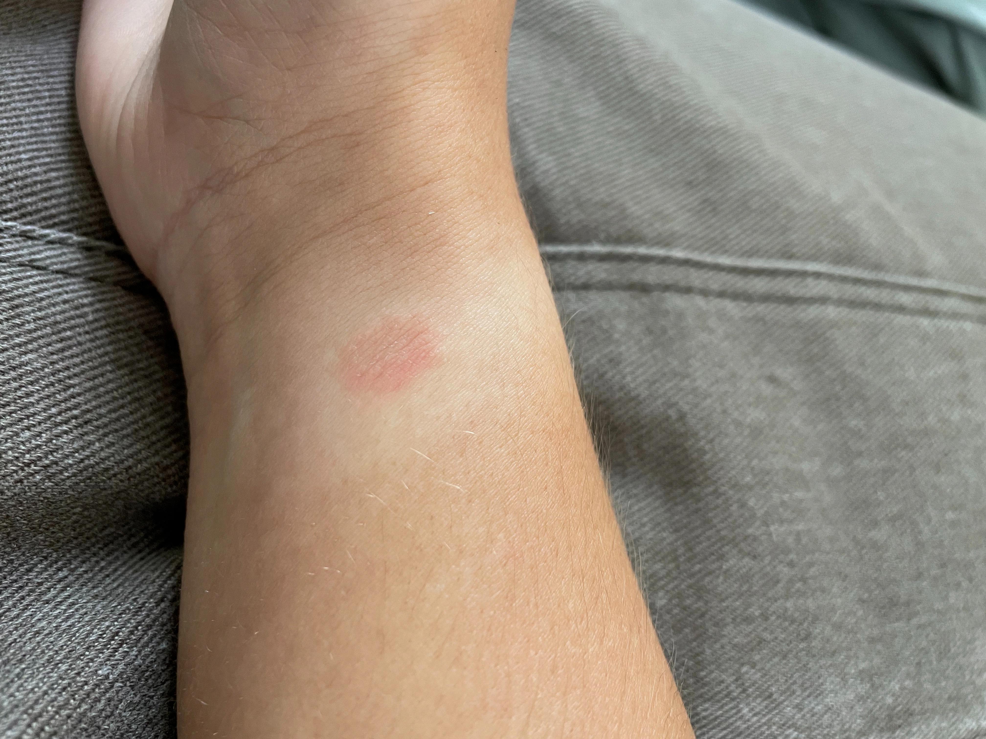 Why Do I Get A Rash After Wearing My Apple Watch Devicemag