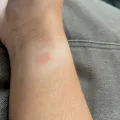 Why Do I Get A Rash After Wearing My Apple Watch ? 1